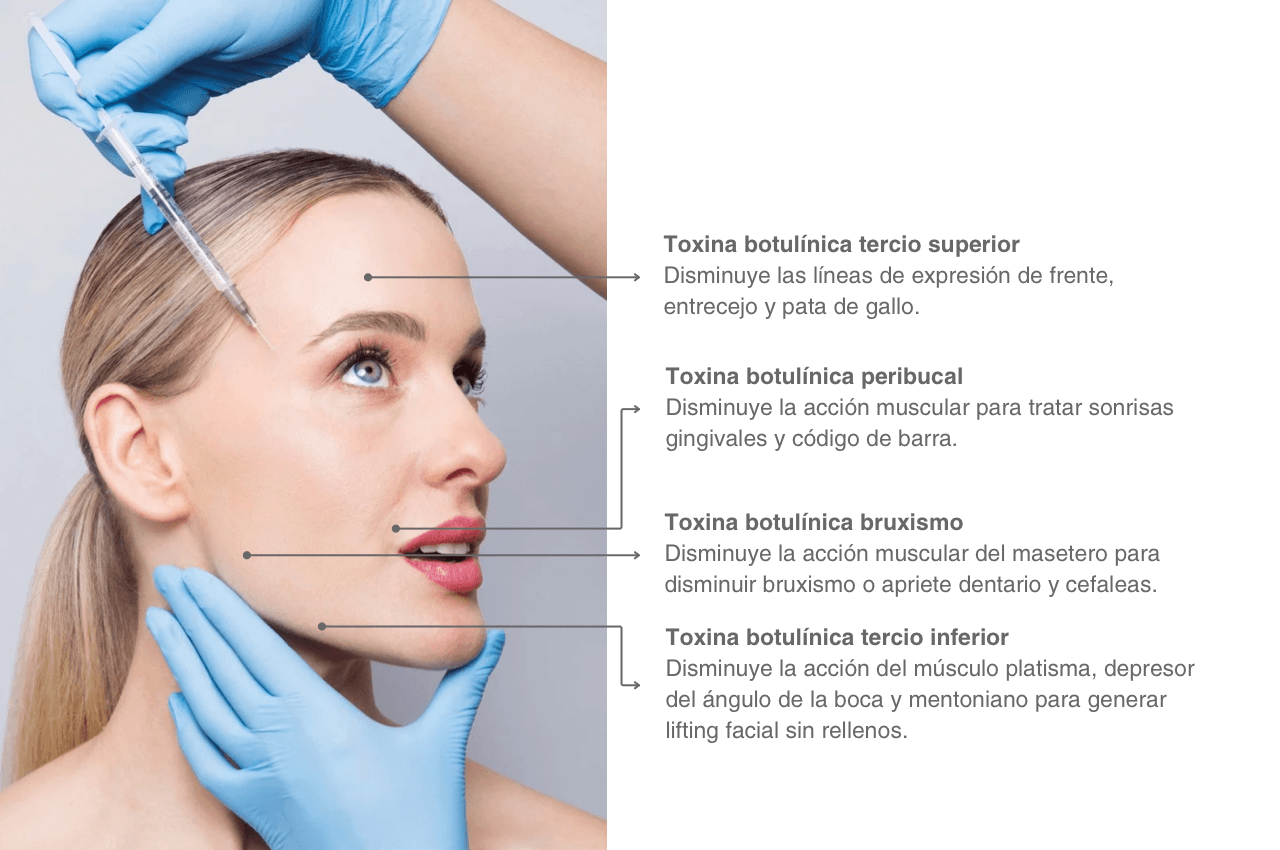 Tratamiento de toxina botulínica en Clínica Dental Torrealba